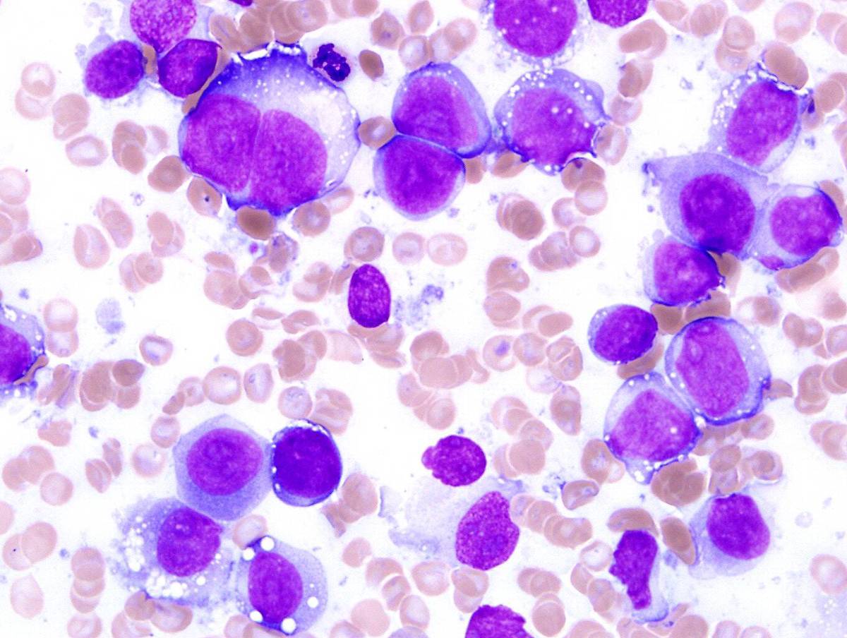 Second bone marrow aspirate shows numerous blasts.